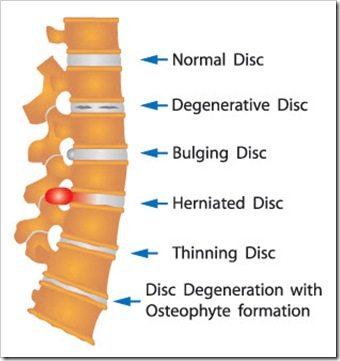 Back Pain Chester VA Arthritis