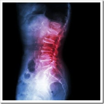 Back Pain Chester VA Arthritis