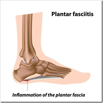 Foot Pain Chester VA Plantar Fasciitis