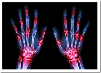 Rheumatoid Chester VA Arthritis Solutions